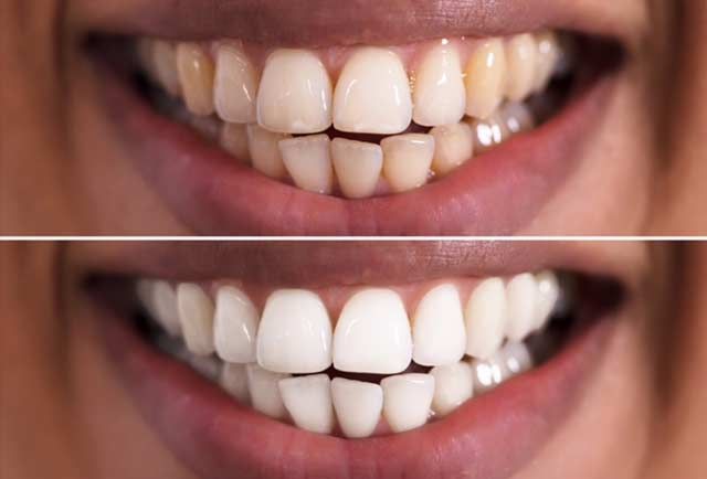 Hampaiden valkaisu - tulokset